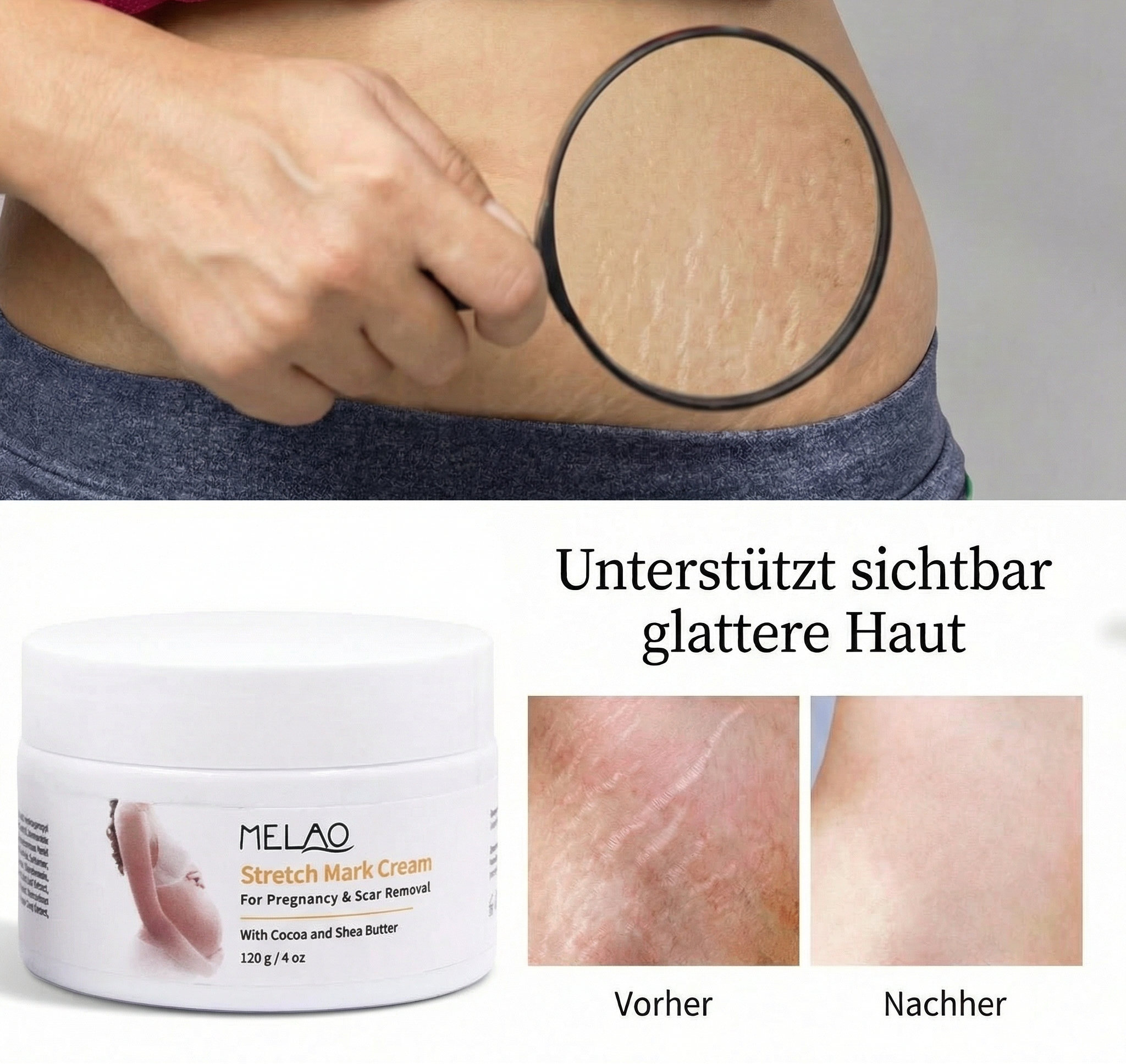 Definora X Melao™ Stretch Mark Cream